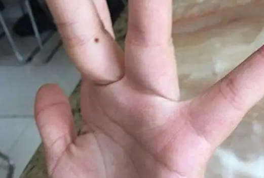 手指有痣代表什么 手指有痣有什么含义